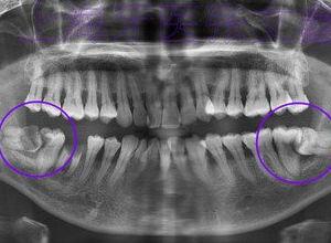 成人磨牙训练视频大全