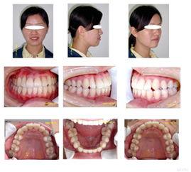 成人磨牙训练视频大全